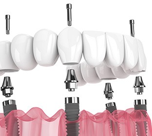 Digital image of implant denture