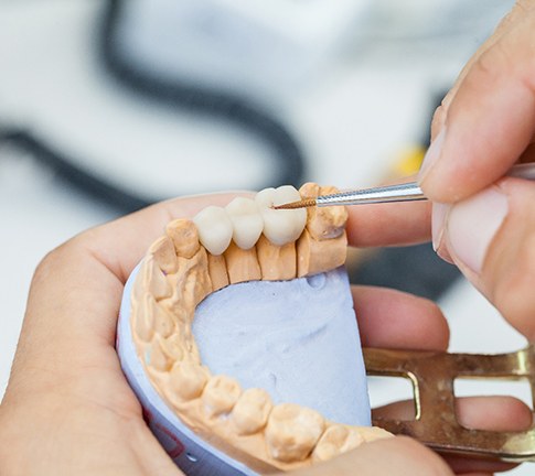 A dental bridge set over a model jaw