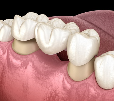 A closeup of a dental bridge against a blue background