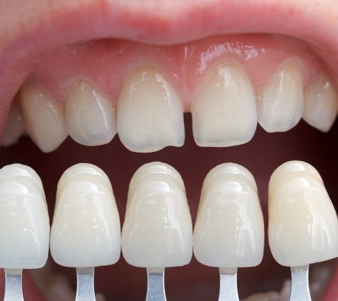 Smile compared with porcelain veneer shade options