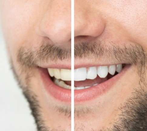 Smile before and after at home teeth whitening