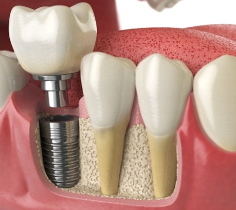 Benefits of dental implants in Raleigh
