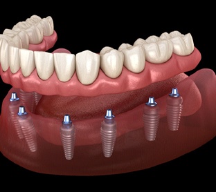Implant dentures in Raleigh