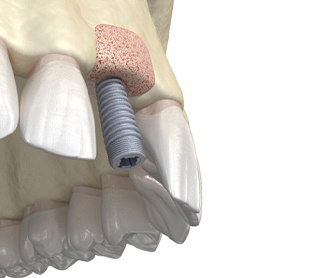 Digital illustration of bone graft in Raleigh