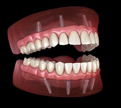 Illustration of implant dentures