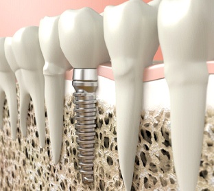 Dental implant in Raleigh