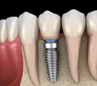 Animated dental implant supported dental crown