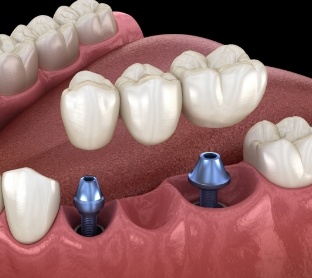 Animated dental implant supported fixed bridge