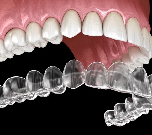 illustration for Invisalign in Raleigh 