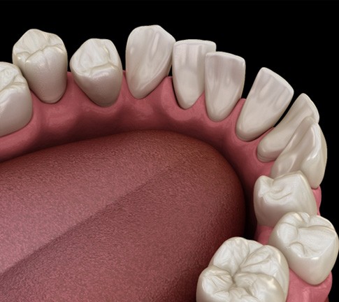 crooked teeth illustration for Invisalign in Raleigh  