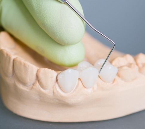 Model smile with fixed bridge restoration