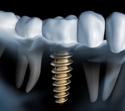 Animated smile with dental implant supported dental crown