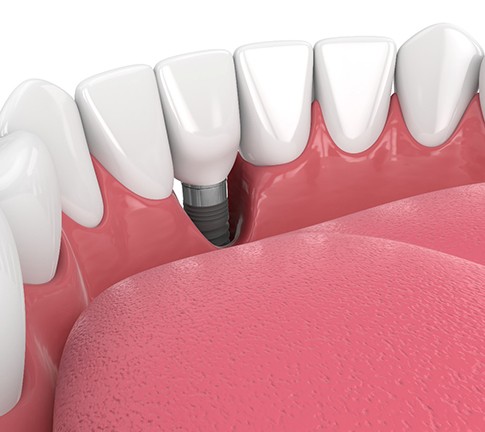 Illustration of bone loss around a failed dental implant in Raleigh, NC