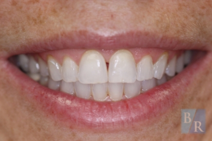 Smile with chipped tooth repaired