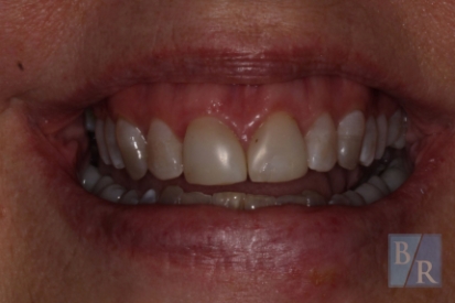 Healthy and evenly spaced top front teeth