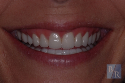Smile after damaged top front two teeth were repaired