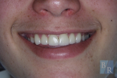 Smile after gaps between teeth were closed with orthodontics
