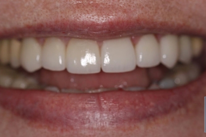 Bright white top front teeth