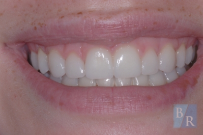 Flawless bright smile after cosmetic dentistry