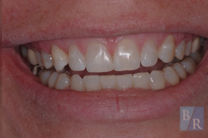 Smile after closing gap between front teeth