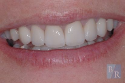 Smile after discoloration is corrected around the gum line of the top front teeth