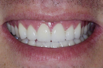 Smile after discoloration is repaired around top front teeth