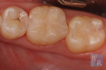 Decay and damaged repaired with tooth colored fillings around the biting surface of teeth
