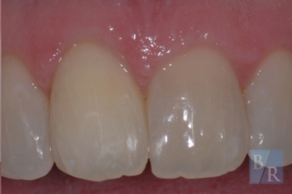 Smile after front eeth are repaired