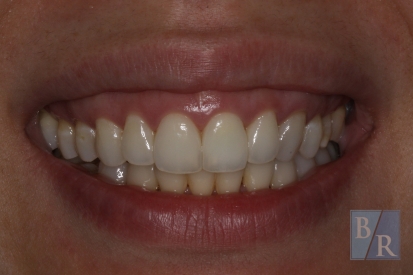 Smile after top front tooth is lightened