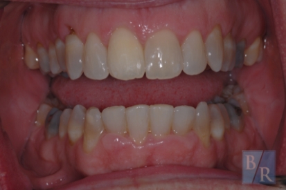 Aligned smile after orthodontic treatment