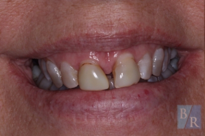 Severely decayed and gapped front teeth