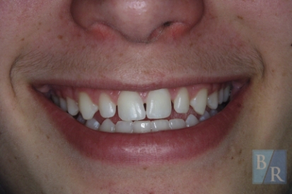 Smile with gaps between teeth