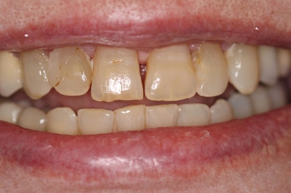 Yellowed top front teeth