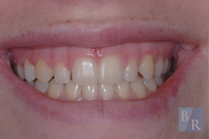 Discolored smile before cosmetic dentistry