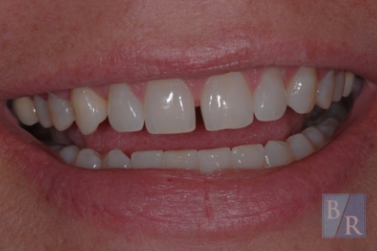 Smile with gap between front teeth