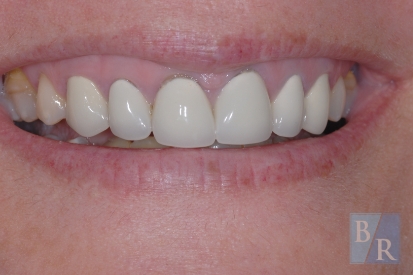 Smile with discoloration at the gum line of top front teeth