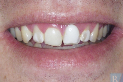 Smile with discoloration around the biting surface of top front teeth