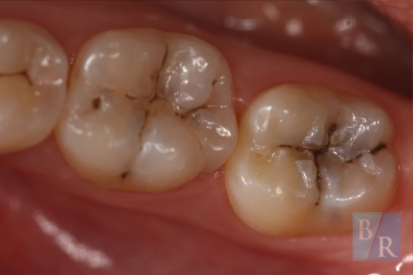 Teeth with decay and damage on the biting suface