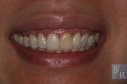Smile with one dark yellow top front tooth