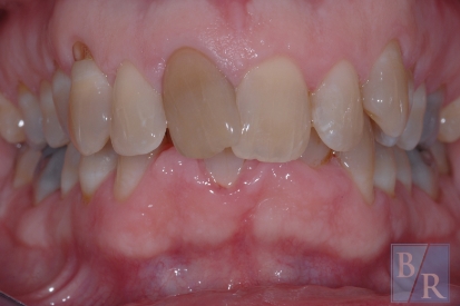 Misaligned smile before orthodontic treatment