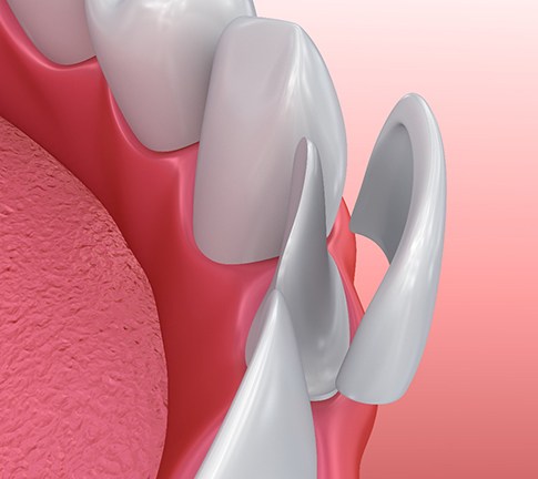 a digital illustration of how veneers work