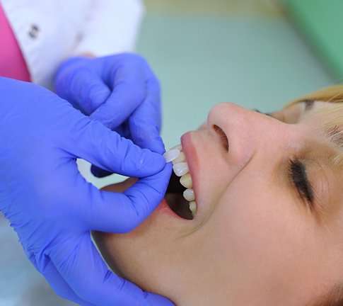 a patient undergoing the veneer process in Raleigh