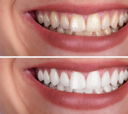 Patient's smile before and after teeth whitening treatment