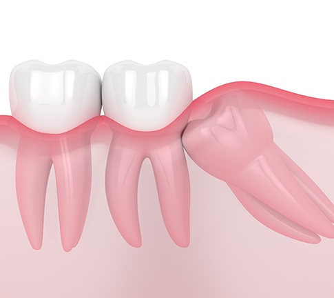 Illustration of molar growing in sideways