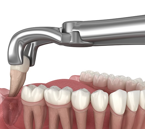 Illustration of wisdom tooth extraction