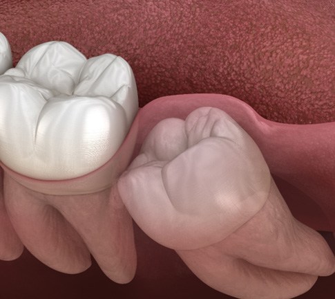 a computer illustration depicting impacted wisdom teeth 