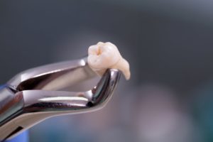 a wisdom tooth that has been extracted
