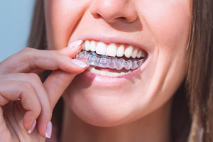 Young woman putting on an Invisalign aligner