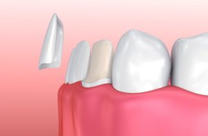 Model of veneer next to prepped tooth