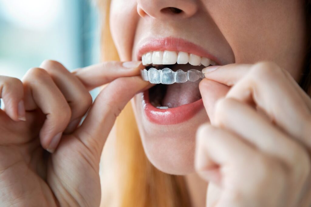 A woman putting an Invisalign tray on her top teeth
